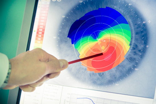 圓錐角膜,圓錐角膜怎么辦,珠海圓錐角膜治療醫(yī)院