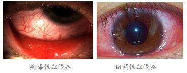 珠海紅眼病醫(yī)院哪家好,得了紅眼病怎么辦,過敏性結膜炎去哪家珠海醫(yī)院 珠海紅眼病醫(yī)院哪家好,得了紅眼病怎么辦,過敏性結膜炎去哪家珠海醫(yī)院