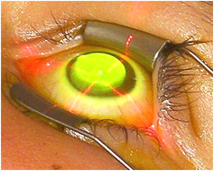 圓錐角膜,圓錐角膜怎么辦,珠海圓錐角膜治療醫(yī)院