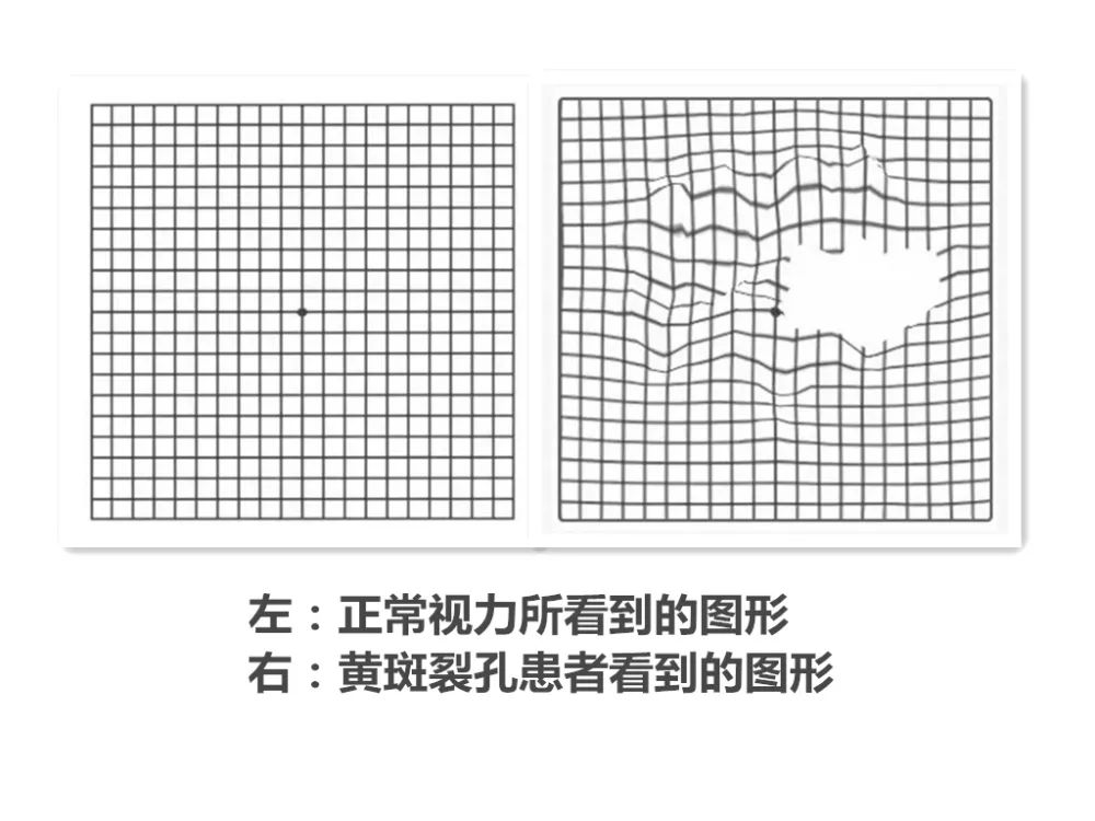 視網(wǎng)膜裂孔如何預(yù)防,視網(wǎng)膜裂孔怎么辦,怎么治療視網(wǎng)膜裂孔,治療視網(wǎng)膜裂孔的辦法 視網(wǎng)膜裂孔如何預(yù)防,視網(wǎng)膜裂孔怎么辦,怎么治療視網(wǎng)膜裂孔,治療視網(wǎng)膜裂孔的辦法